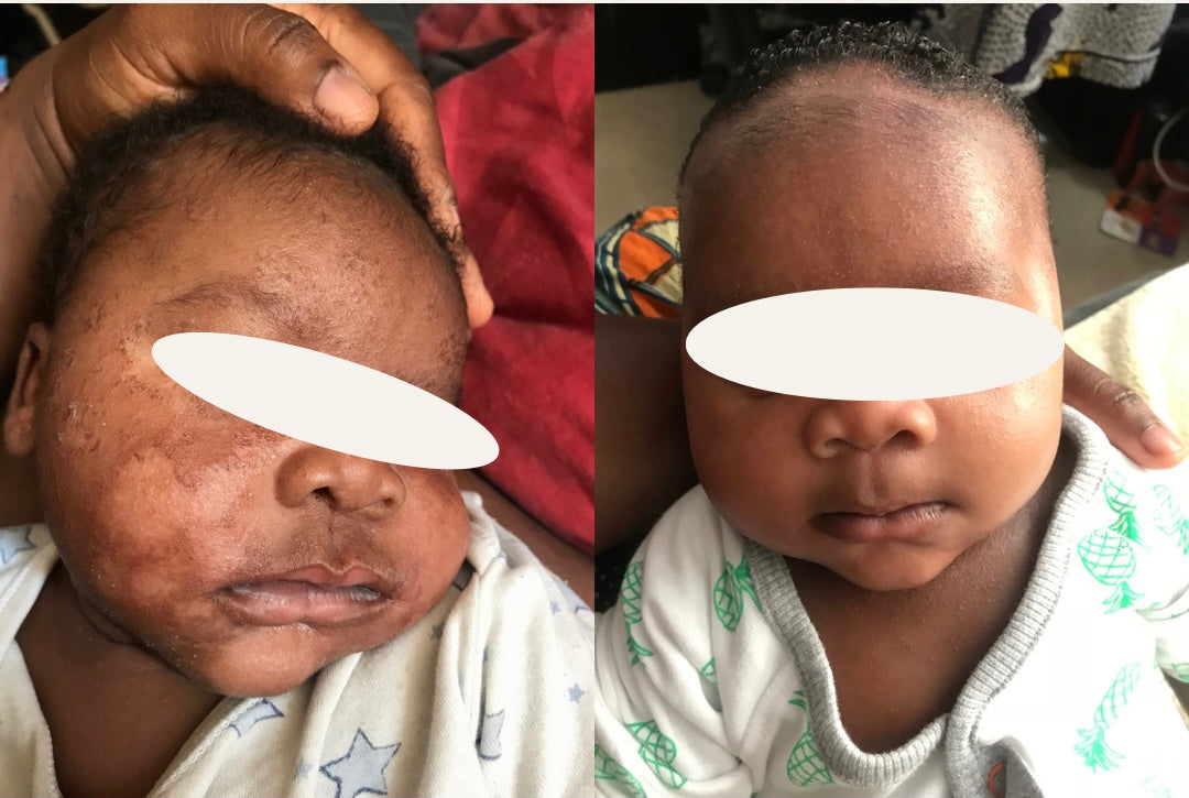 ECZEMA & PSORIASIS CARE (SUPER SENSITIVE DRY SKIN)