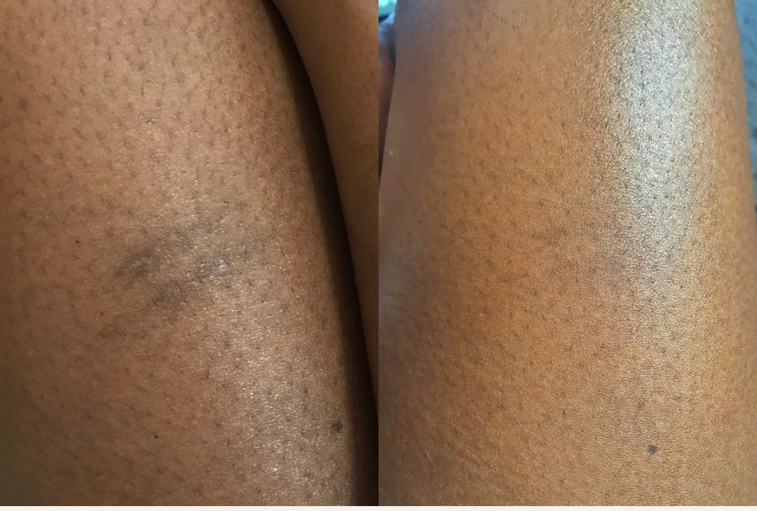 HYPERPIGMENTATION