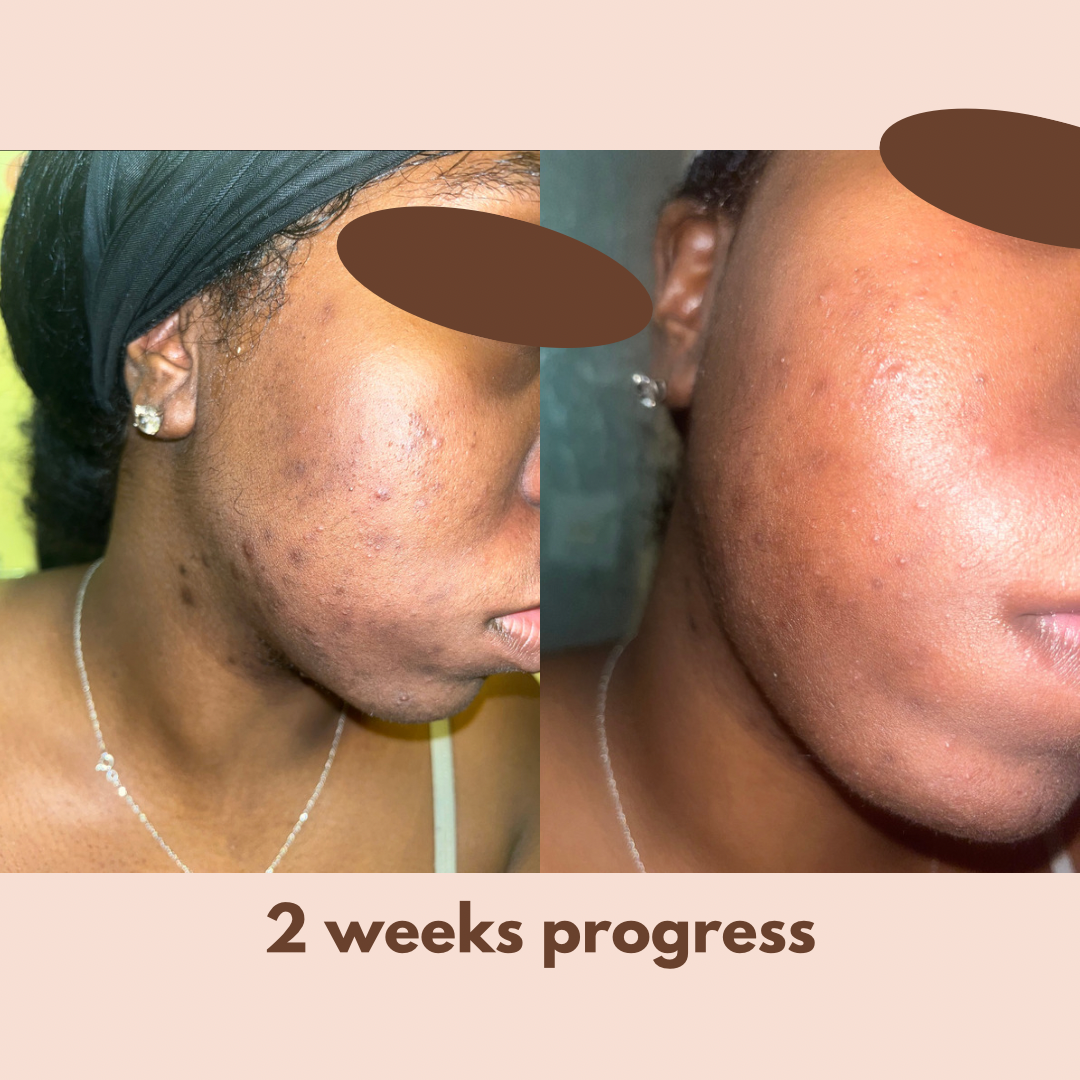 Fade Cream (Alpha Arbutin + Kojic Acid + Hyaluronic Acid)