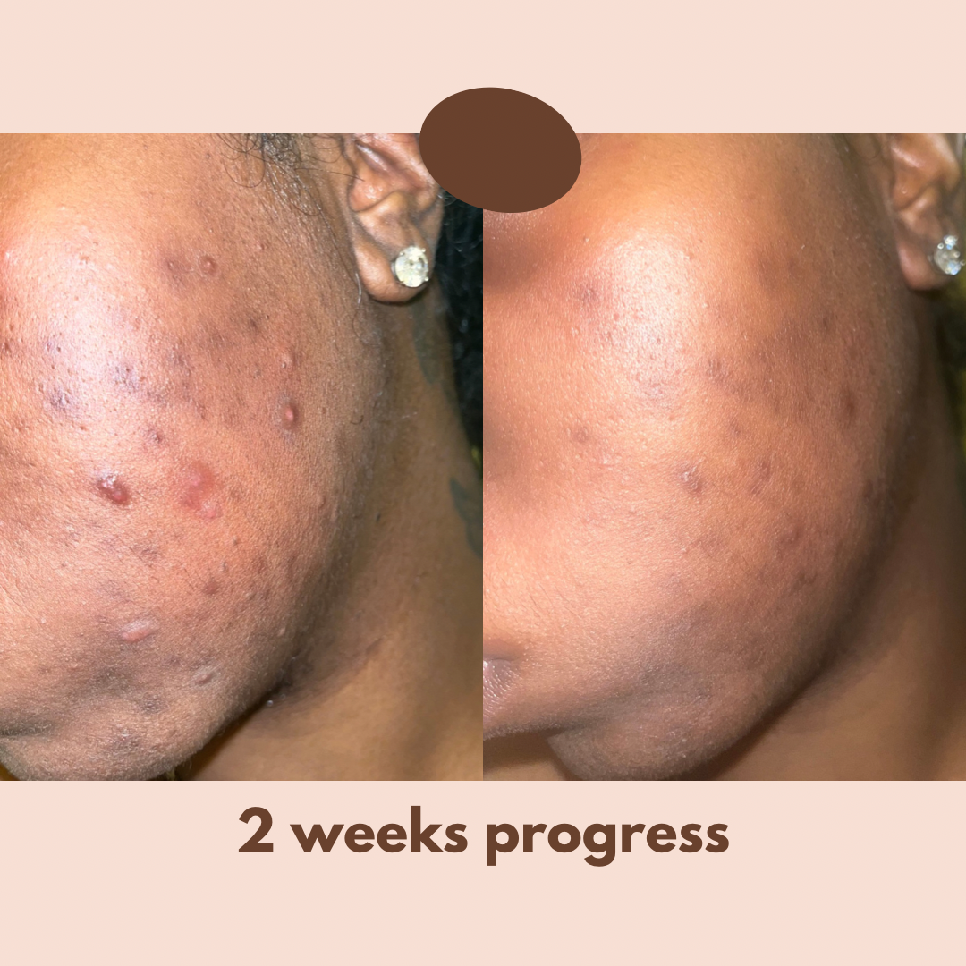 Fade Cream (Alpha Arbutin + Kojic Acid + Hyaluronic Acid)