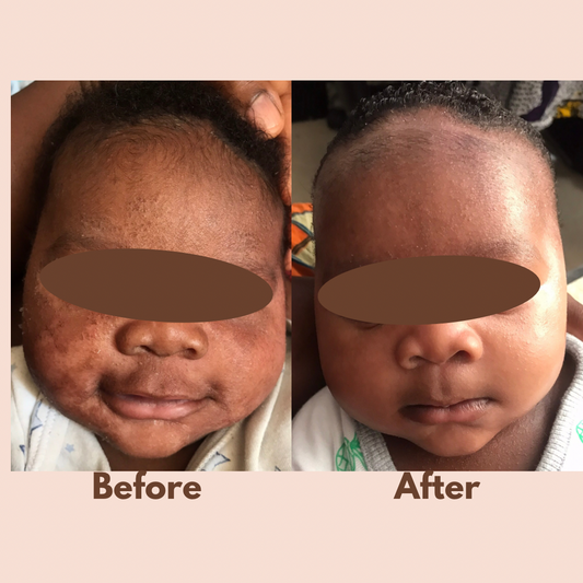 No More Itchy Skin Salve